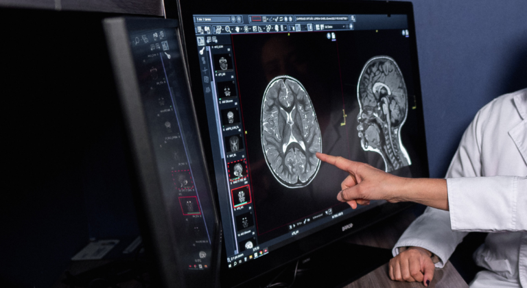 Tumores Cerebrales: una alerta para no ignorar los síntomas