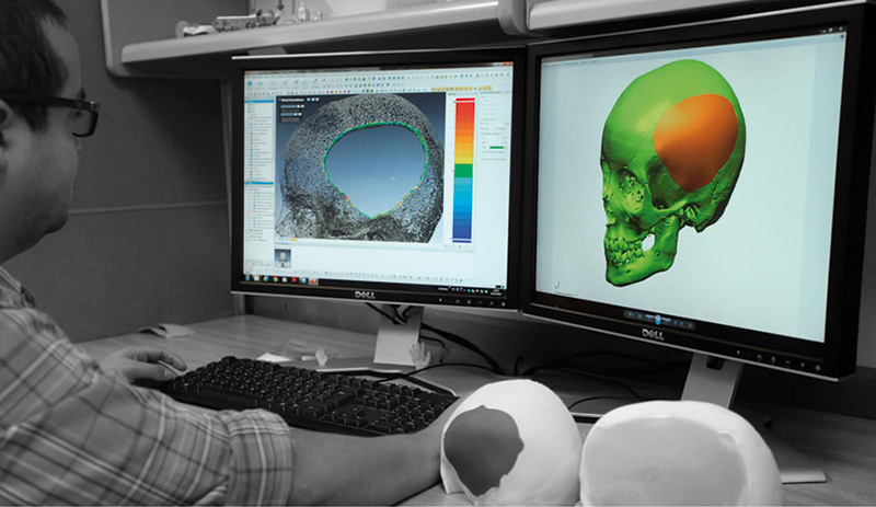 Implantes craneales